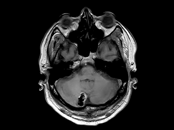 T1w FFE <b>Compressed SENSE</b>