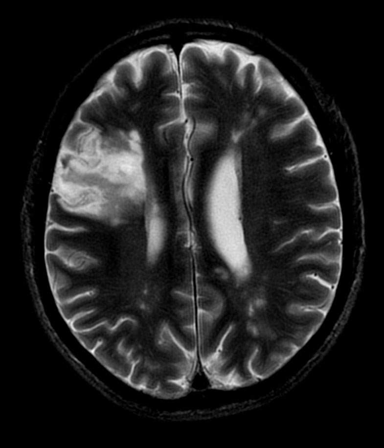 T2w TSE MultiVane XD