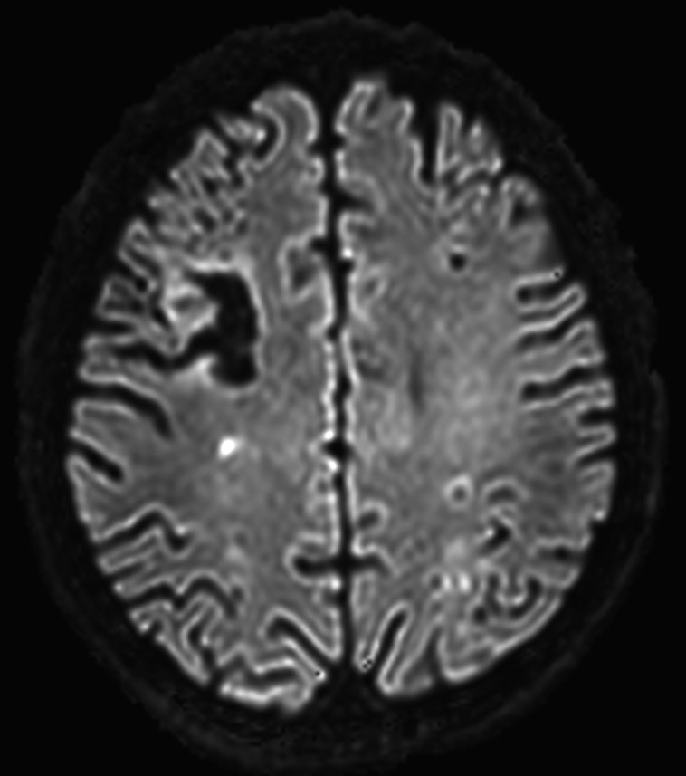 DWI b2000 (computed)