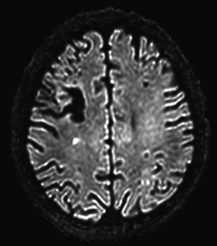 DWI b3000 (computed)