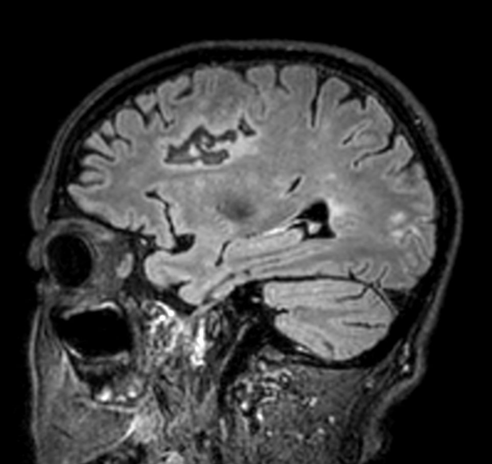 3D T2w FLAIR <b>Compressed SENSE</b>
