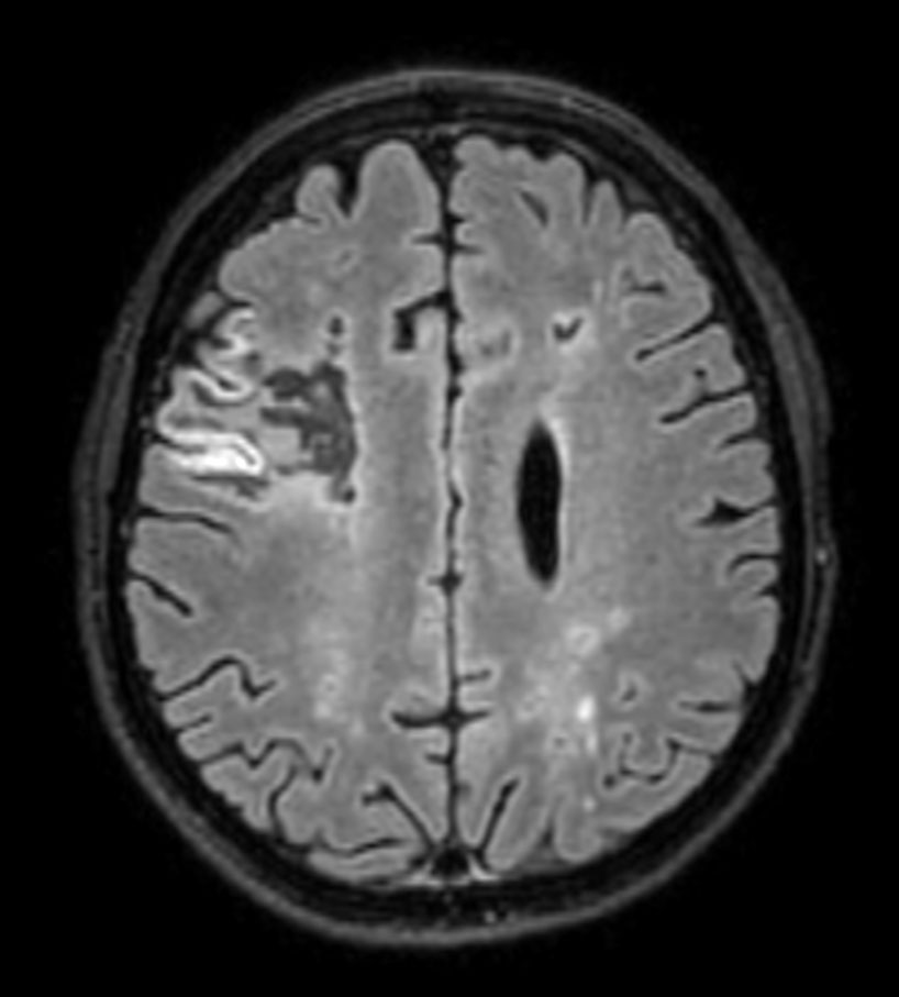 3D T2w FLAIR (reformat) <b>Compressed SENSE</b>