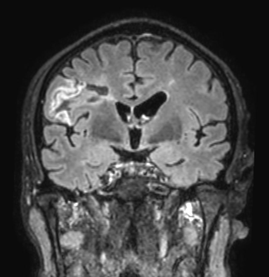 3D T2w FLAIR (reformat) <b>Compressed SENSE</b>