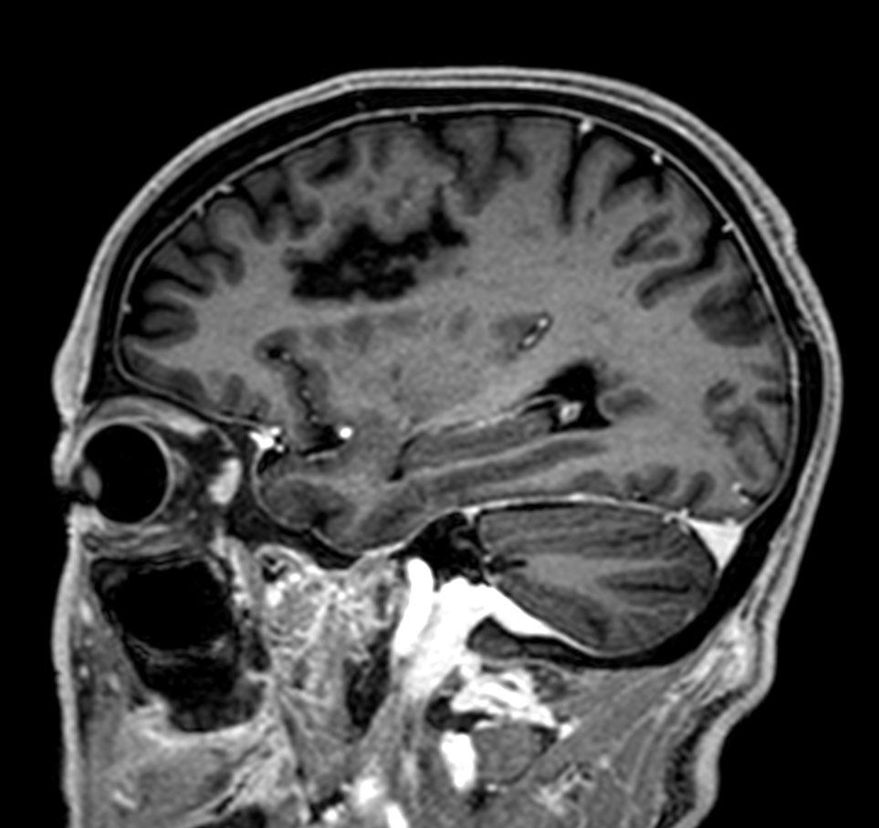 3D T1w mDIXON XD <b>Compressed SENSE</b>
