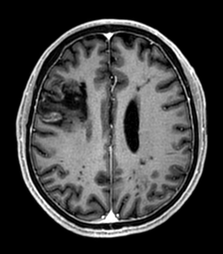3D T1w mDIXON XD (reformat) <b>Compressed SENSE</b>