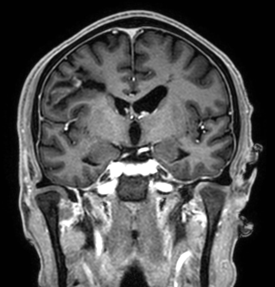 3D T1w mDIXON XD (reformat) <b>Compressed SENSE</b>