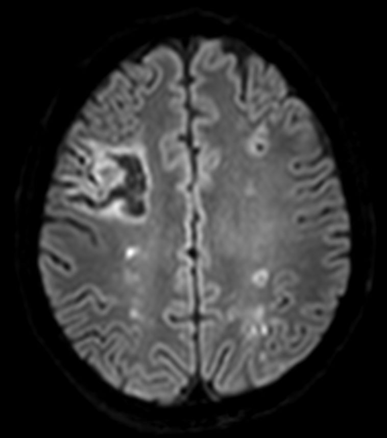 brain-lesions-with-computed-dwi-philips-mr-body-map