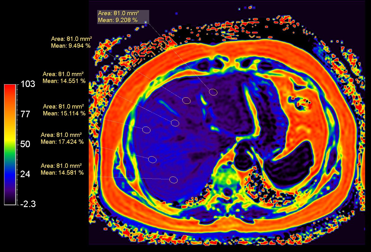mDIXON Quant (Fat Fraction)