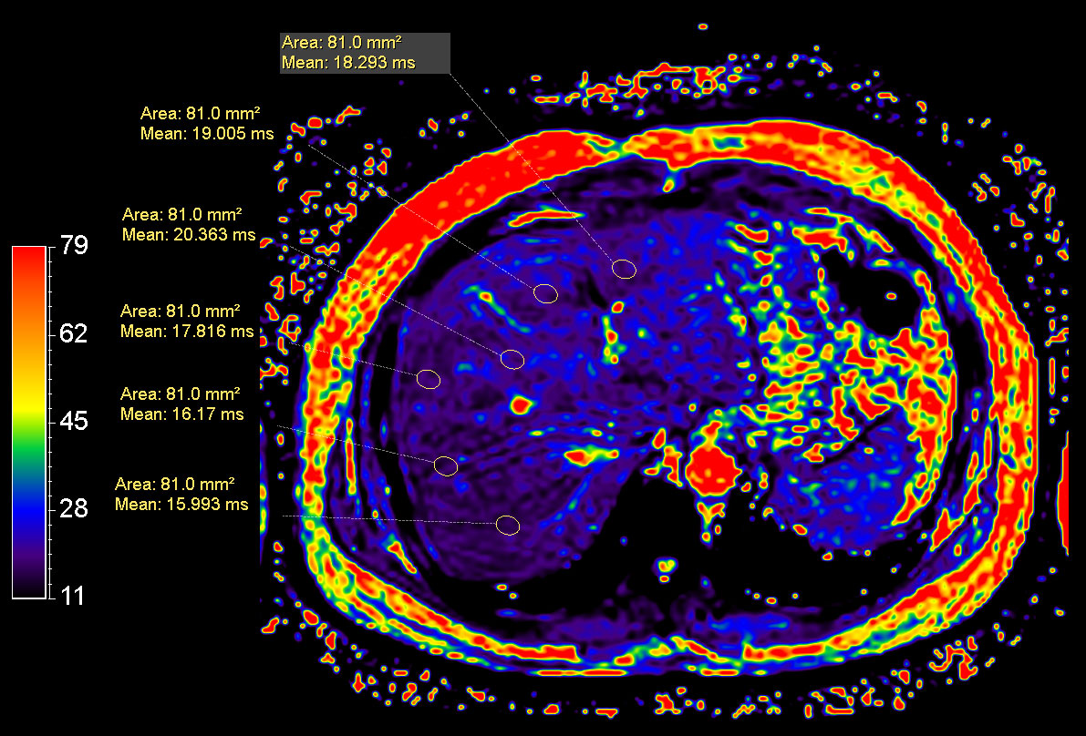 mDIXON Quant (T2 star)