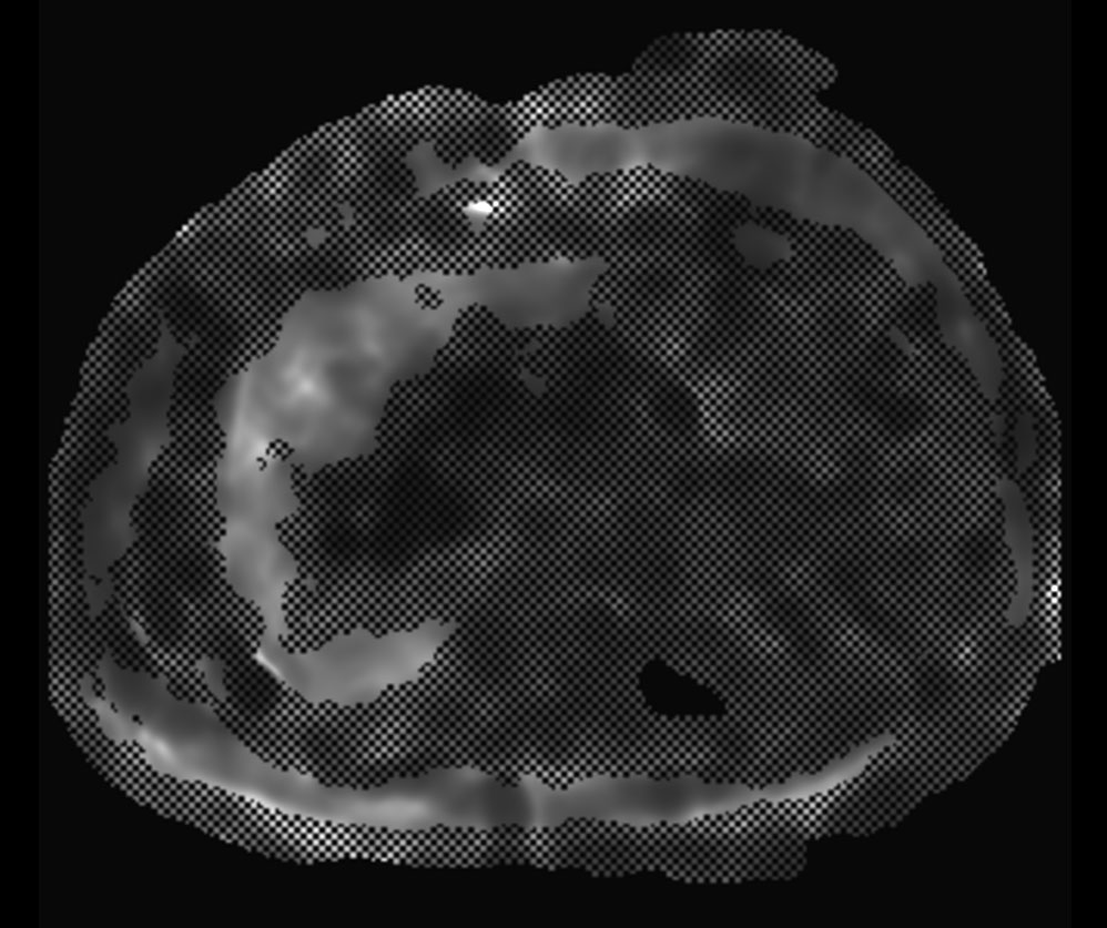 MR Elastography (confidence map) <b>FFE, 18 sec BH/1 slice</b>