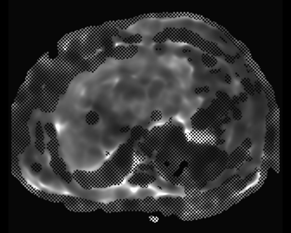 MR Elastography (confidence map) <b>SE-EPI, 13 sec BH/4 slices</b>
