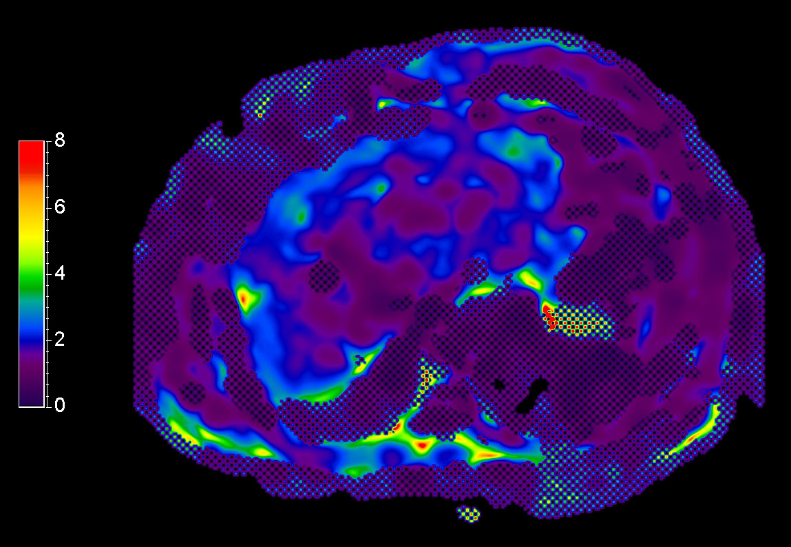 MR Elastography (stiffness map) <b>SE-EPI, 13 sec BH/4 slices</b>
