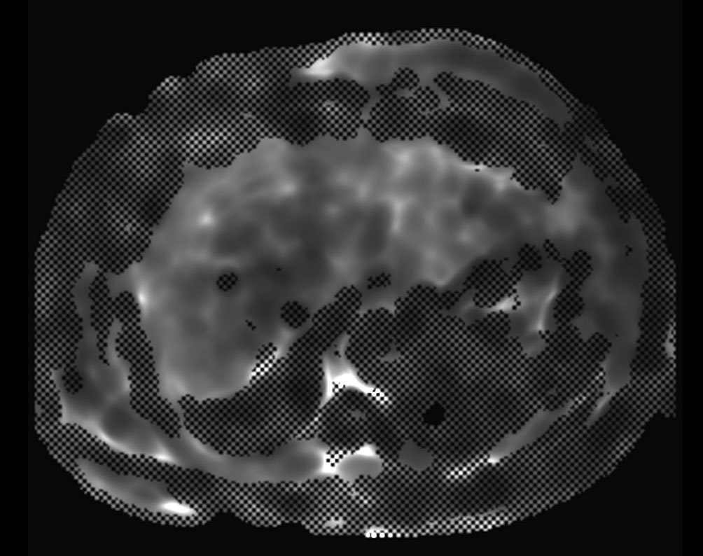 MR Elastography (confidence map) <b>SE-EPI, 14 sec BH/8 slices</b>