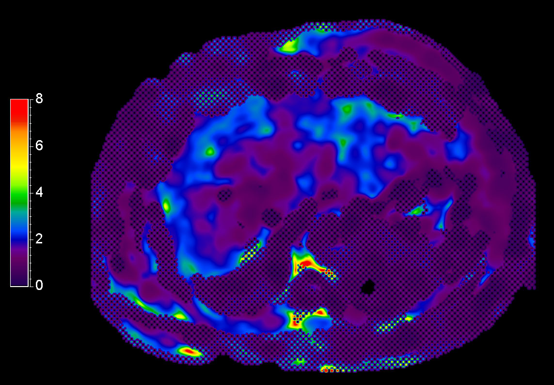 MR Elastography (stiffness map) <b>SE-EPI, 14 sec BH/8 slices</b>