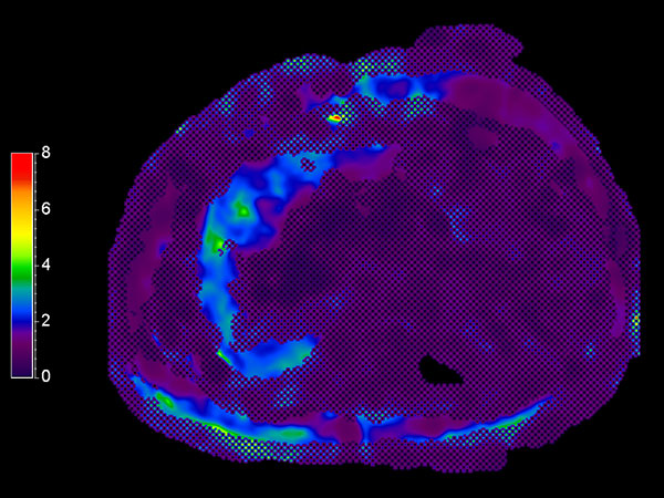 MR Elastography (stiffness map) <b>FFE, 18 sec BH/1 slice</b>