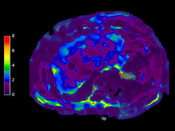 MR Elastography (stiffness map) <b>SE-EPI, 13 sec BH/4 slices</b>