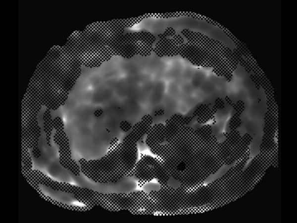 MR Elastography (confidence map) <b>SE-EPI, 14 sec BH/8 slices</b>