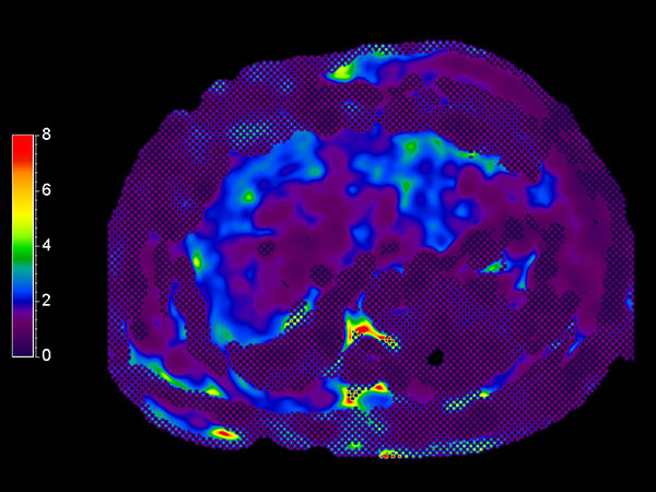 MR Elastography (stiffness map) <b>SE-EPI, 14 sec BH/8 slices</b>