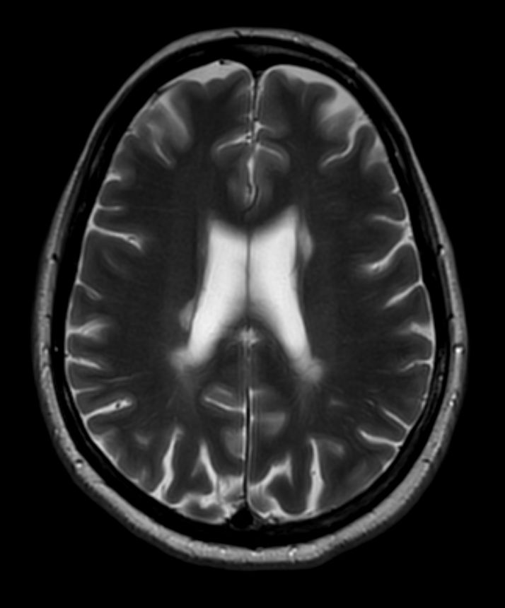 T2w TSE MultiVane XD