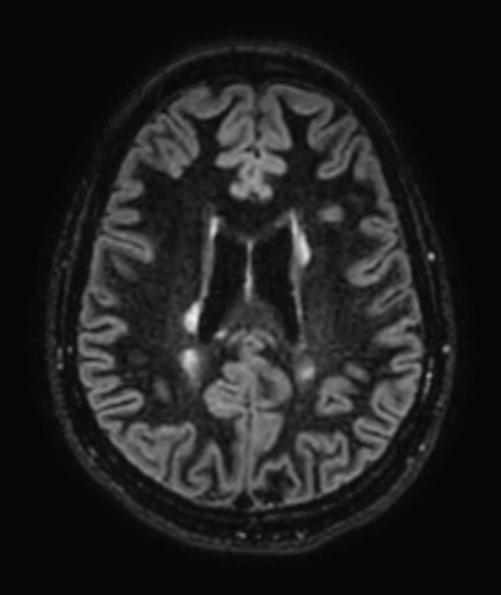 3D Double IR BrainVIEW (reformat) <b>Compressed SENSE</b>