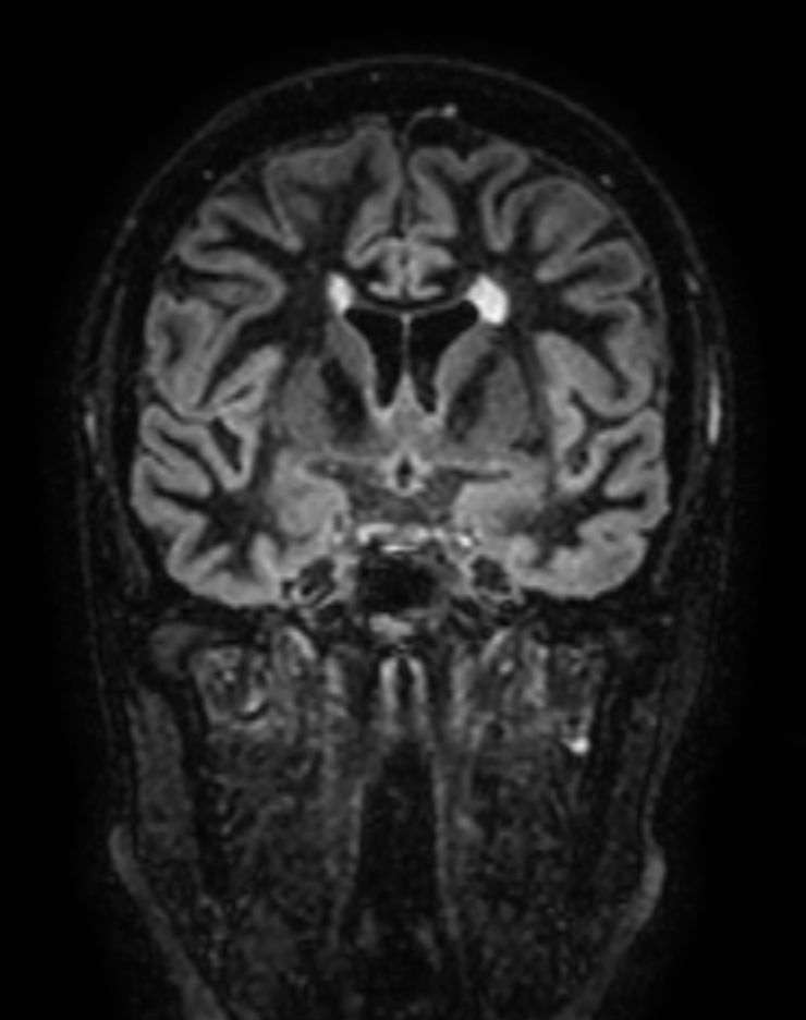 3D Double IR BrainVIEW (reformat) <b>Compressed SENSE</b>