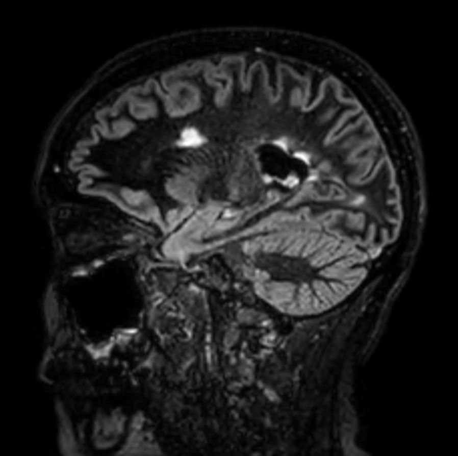 3D Double IR BrainVIEW <b>Compressed SENSE</b>
