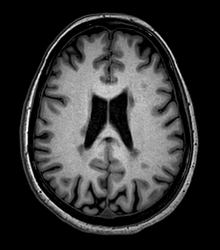 3D T1w FFE <b>Compressed SENSE</b>
