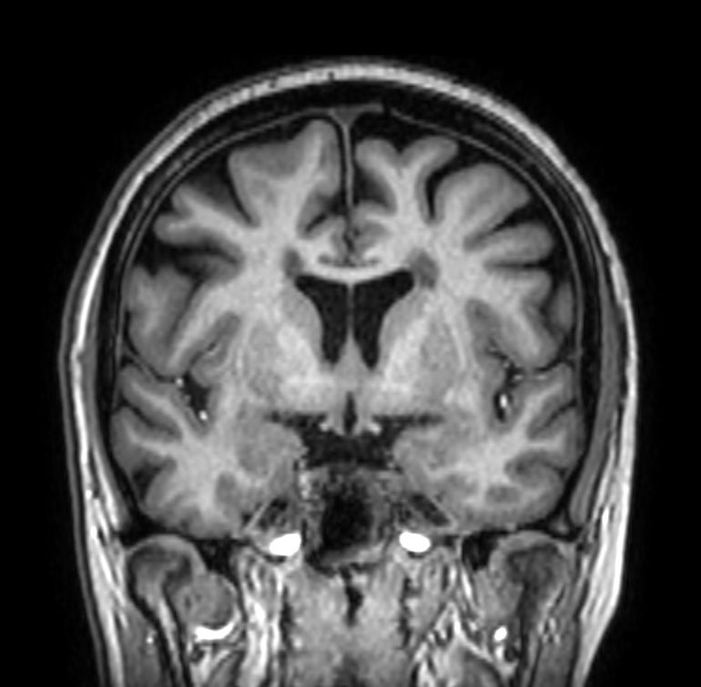 3D T1w FFE (reformat) <b>Compressed SENSE</b>
