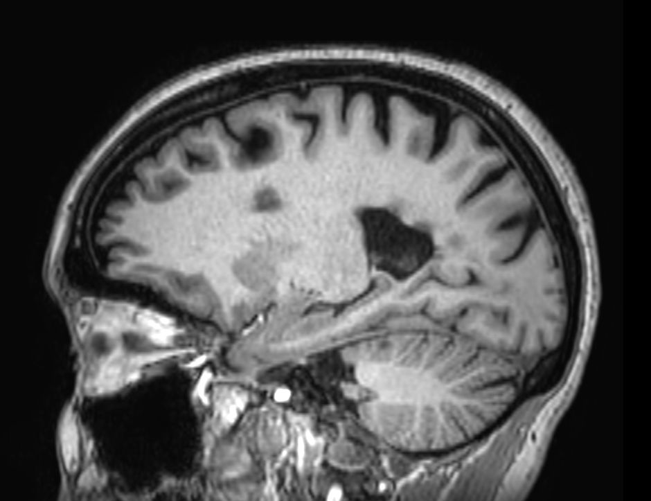 3D T1w FFE (reformat) <b>Compressed SENSE</b>