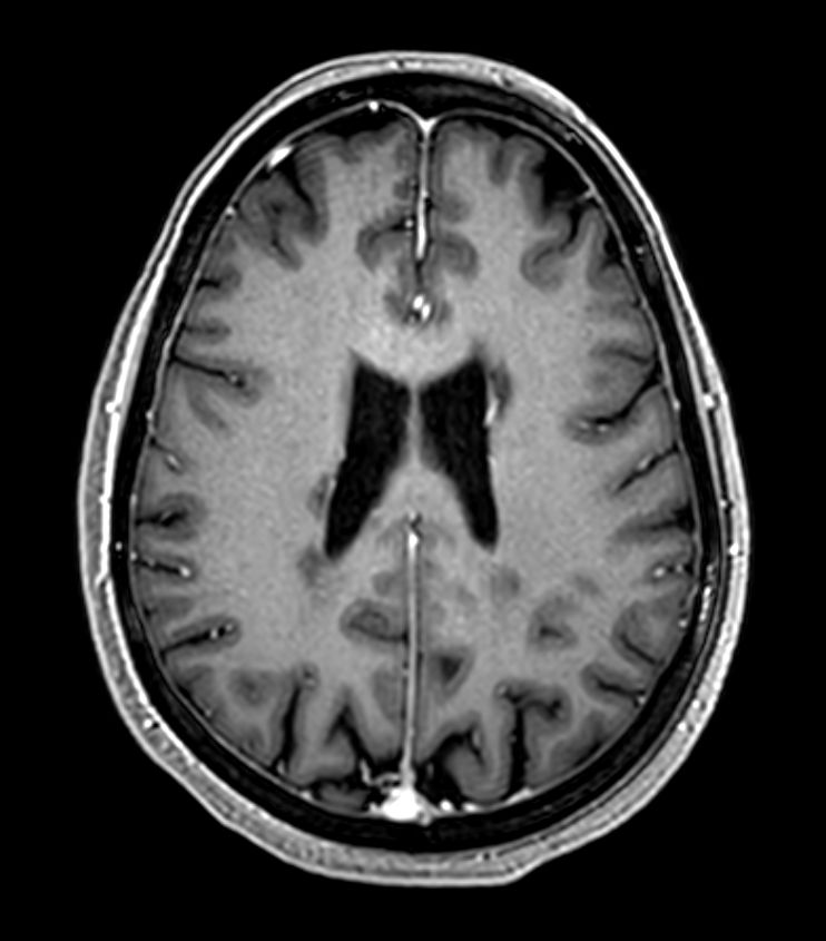 3D T1w FFE +Gado <b>Compressed SENSE</b>