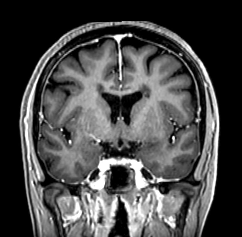 3D T1w FFE (reformat) +Gado <b>Compressed SENSE</b>