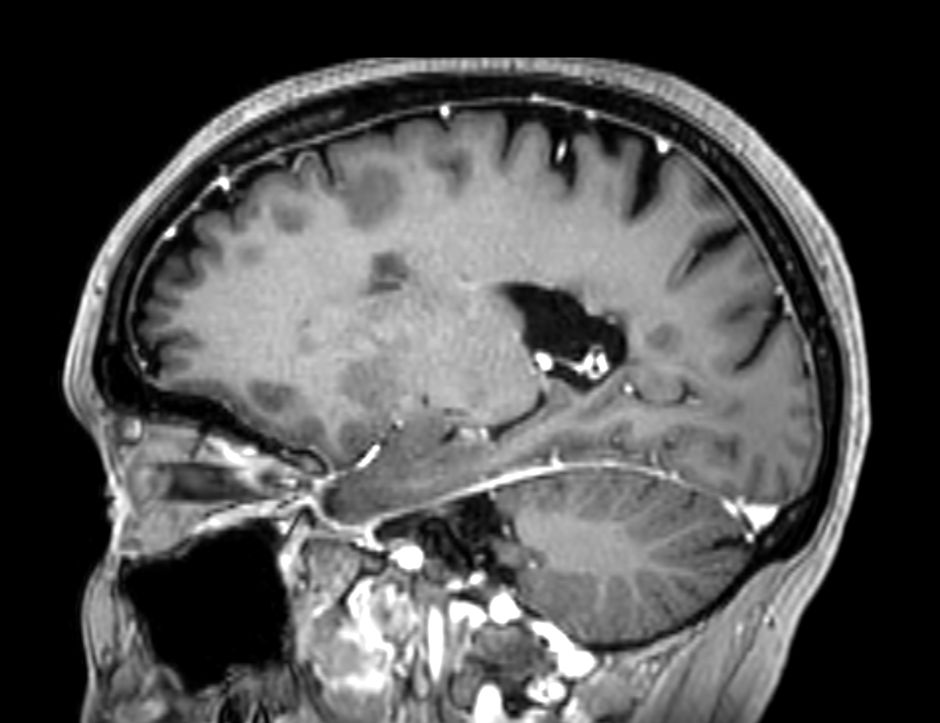 3D T1w FFE (reformat) +Gado <b>Compressed SENSE</b>