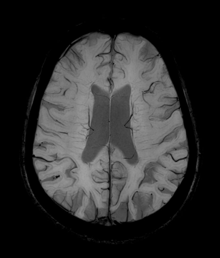 SWIp 4 echoes (minIP)