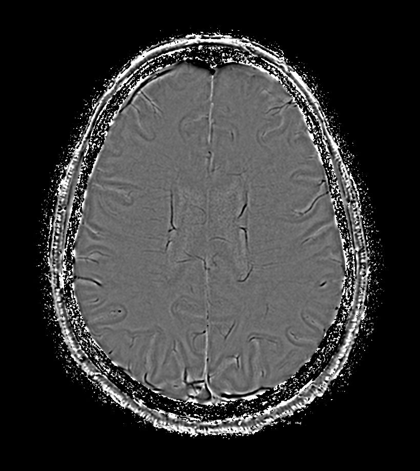 SWIp 4 echoes (Phase)