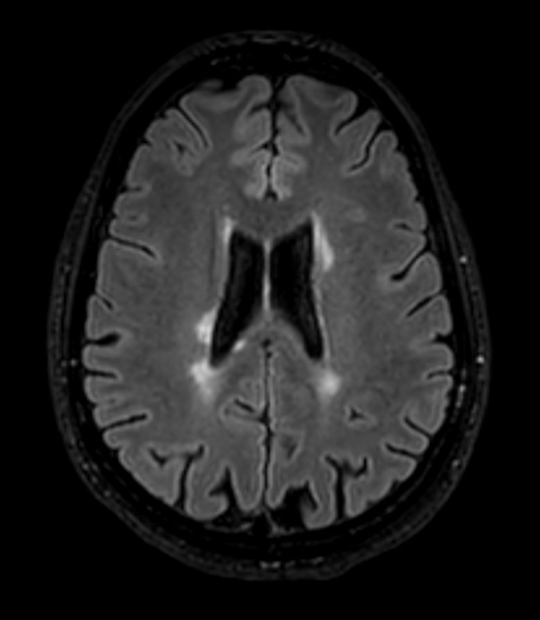 3D T2w FLAIR BrainVIEW <b>Compressed SENSE</b>