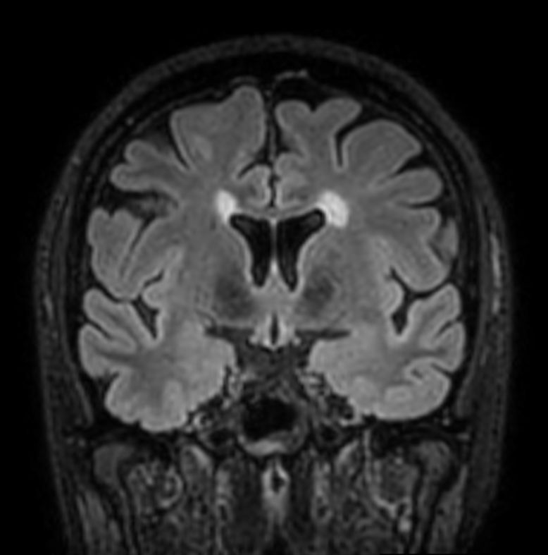 3D T2w FLAIR BrainVIEW (reformat) <b>Compressed SENSE</b>