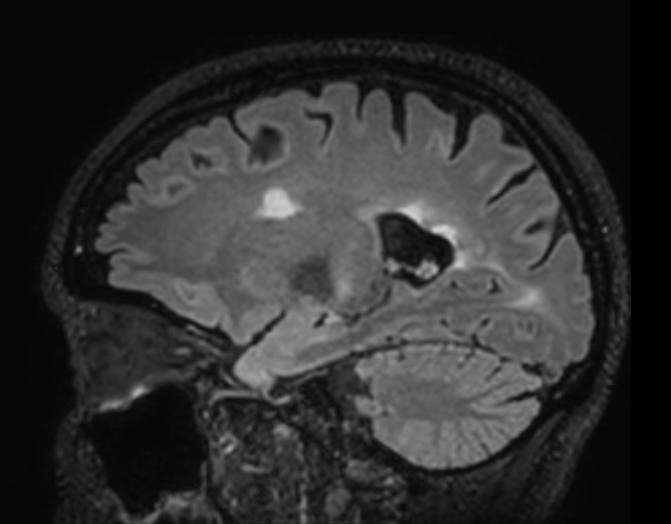 3D T2w FLAIR BrainVIEW (reformat) <b>Compressed SENSE</b>