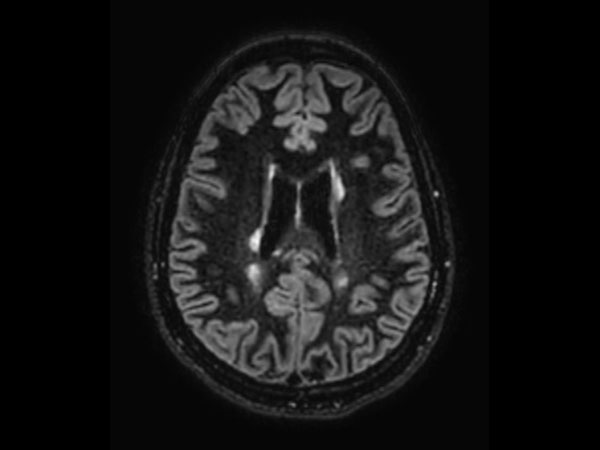 3D Double IR BrainVIEW (reformat) <b>Compressed SENSE</b>