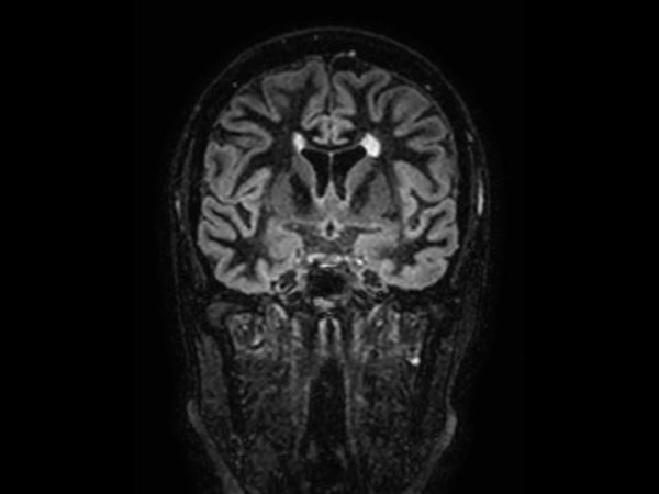 3D Double IR BrainVIEW (reformat) <b>Compressed SENSE</b>