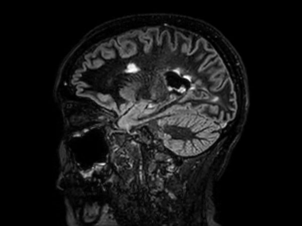 3D Double IR BrainVIEW <b>Compressed SENSE</b>