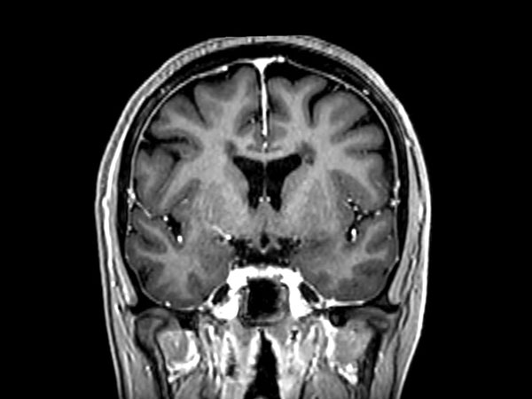 3D T1w FFE (reformat) +Gado <b>Compressed SENSE</b>