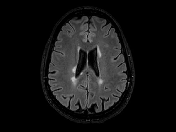 3D T2w FLAIR BrainVIEW <b>Compressed SENSE</b>