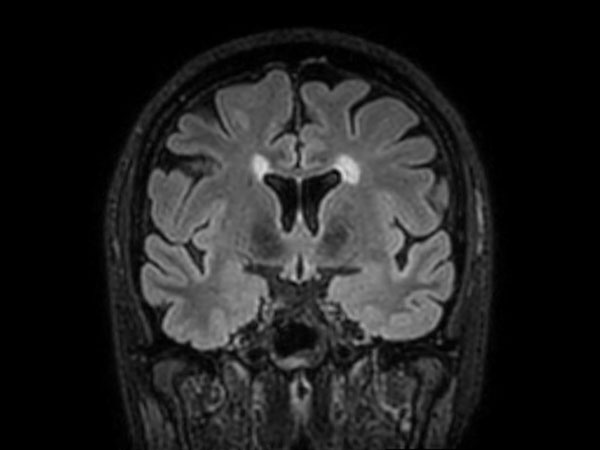 3D T2w FLAIR BrainVIEW (reformat) <b>Compressed SENSE</b>