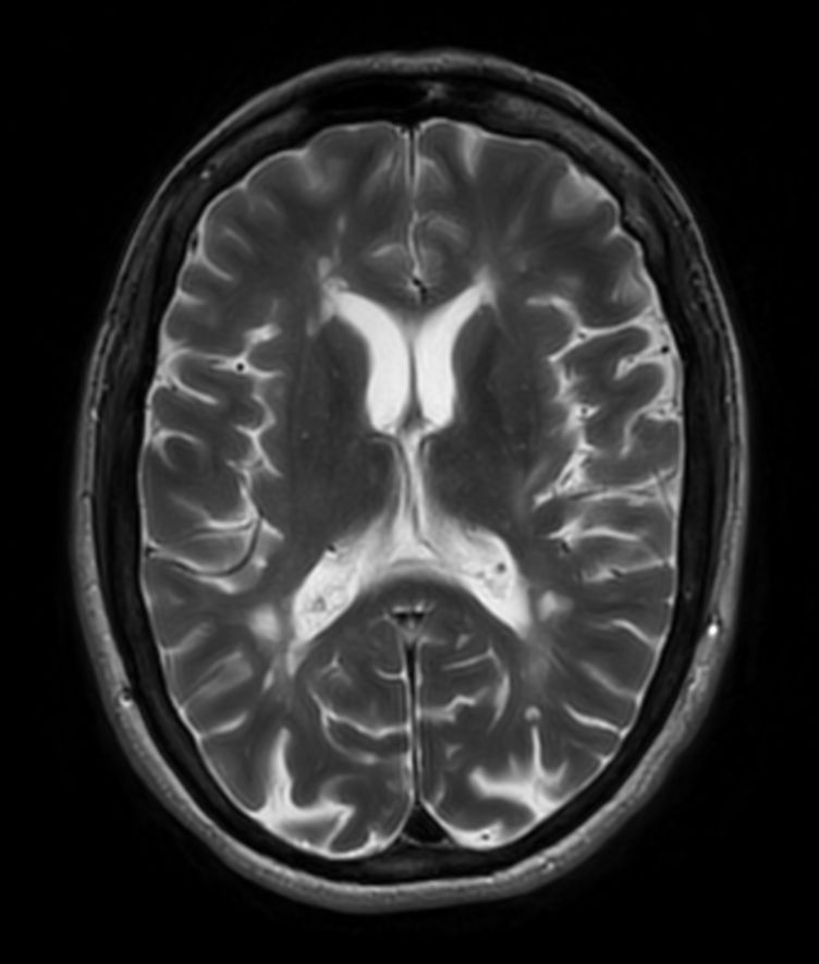 T2w TSE MultiVane XD