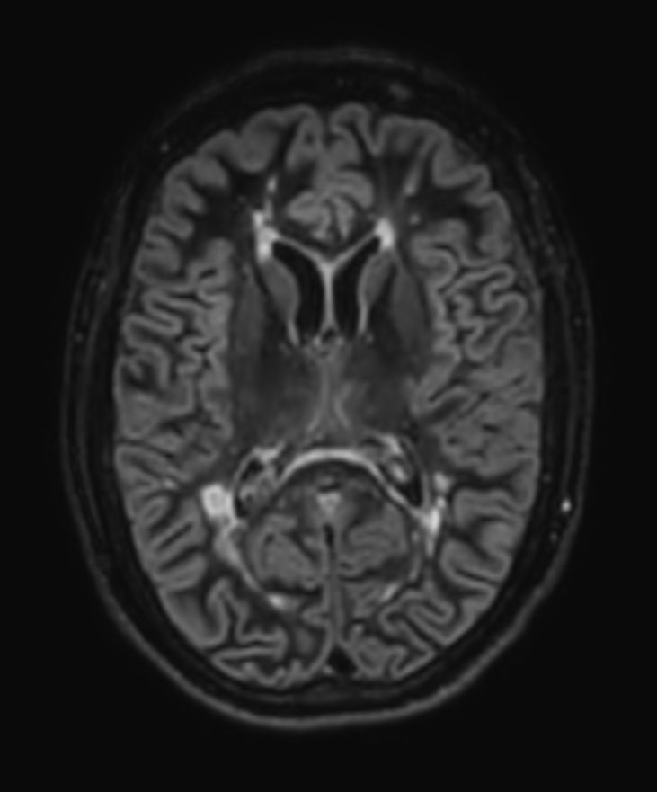 3D Double IR BrainVIEW (reformat) <b>Compressed SENSE</b>