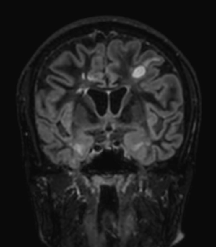 3D Double IR BrainVIEW (reformat) <b>Compressed SENSE</b>