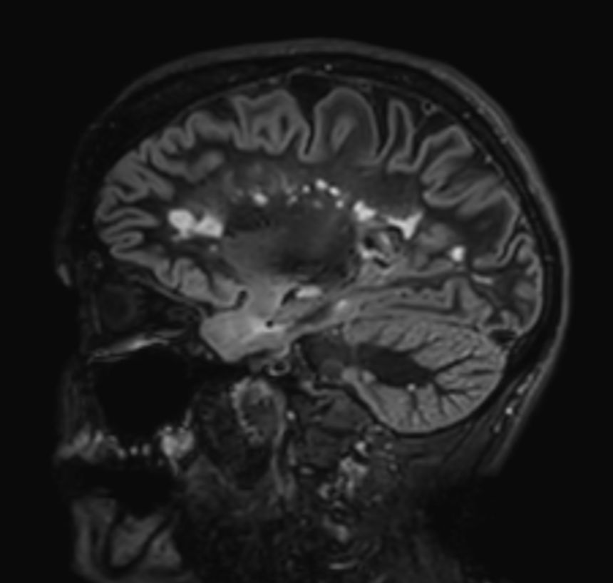 3D Double IR BrainVIEW <b>Compressed SENSE</b>