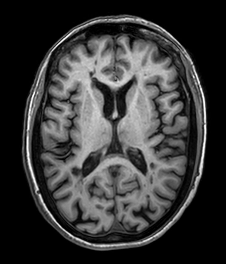 3D T1w FFE <b>Compressed SENSE</b>