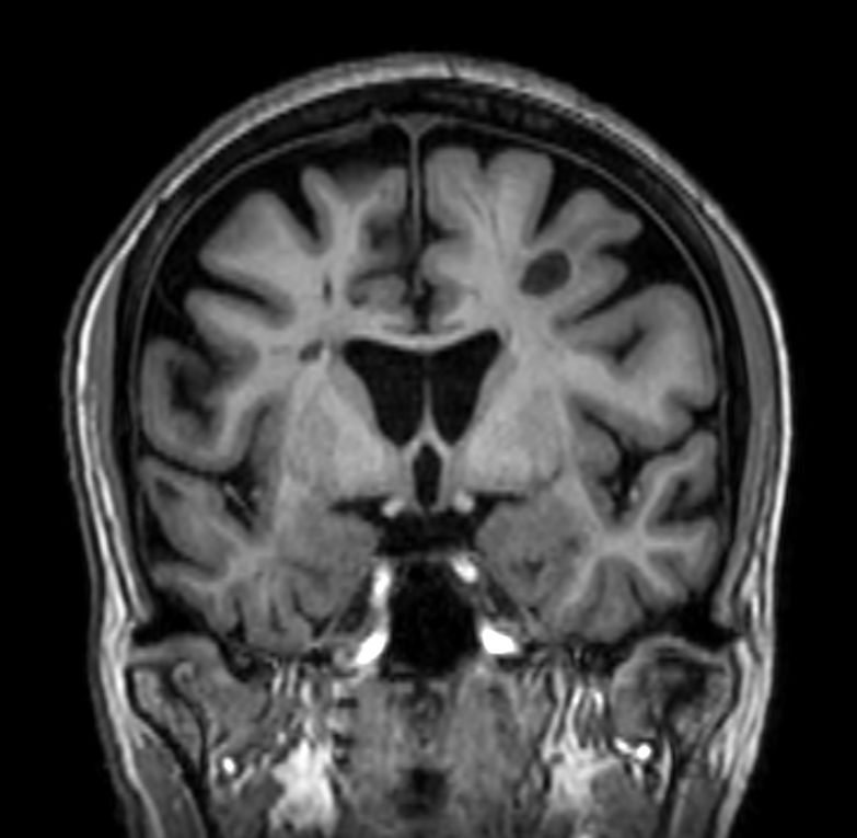 3D T1w FFE (reformat) <b>Compressed SENSE</b>