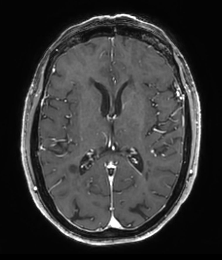 3D T1w FFE +Gado <b>Compressed SENSE</b>